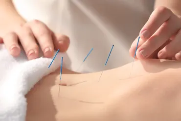 Acupuncture